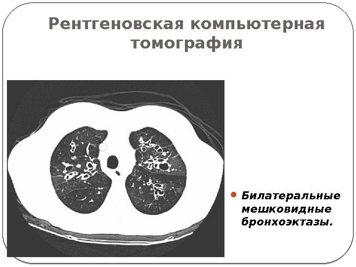 Рентгеновская компьютерная томография Билатеральные мешковидные бронхоэктазы.  
