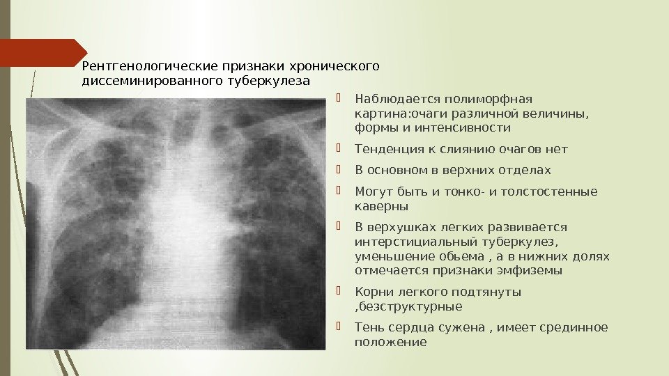  Наблюдается полиморфная картина: очаги различной величины,  формы и интенсивности Тенденция к слиянию