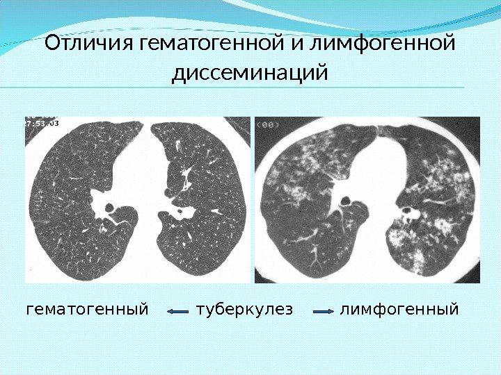 Отличия гематогенной и лимфогенной диссеминаций гематогенный   туберкулез   лимфогенный 