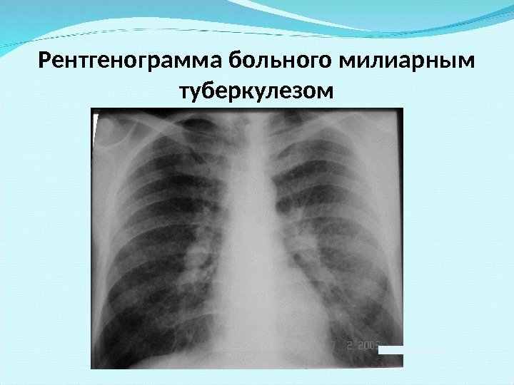 Рентгенограмма больного милиарным туберкулезом 