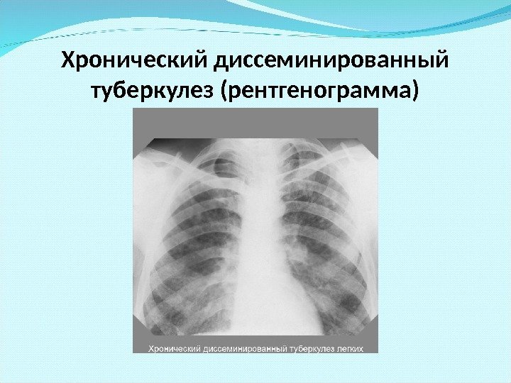 Хронический диссеминированный туберкулез (рентгенограмма) 
