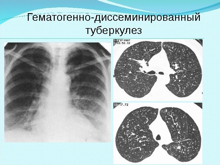 Гематогенно-диссеминированный туберкулез 