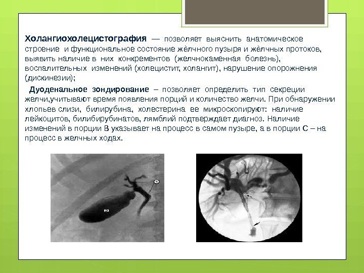 Холангиохолецистография  — позволяет выяснить анатомическое  строение и функциональное состояние ж лчного пузыря