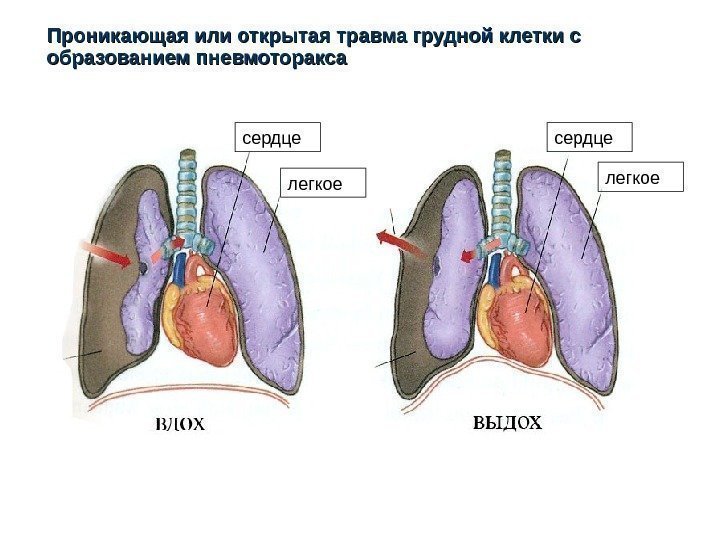 Проникающая или открытая травма грудной клетки с образованием пневмоторакса сердце легкоесердце 