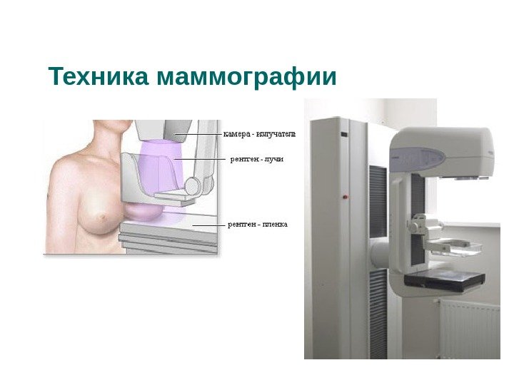 Техника маммографии 