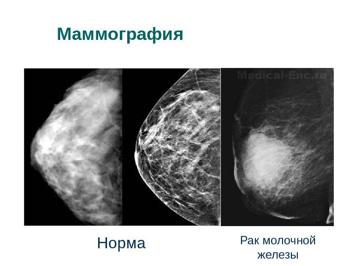 Маммография Норма Рак молочной железы 