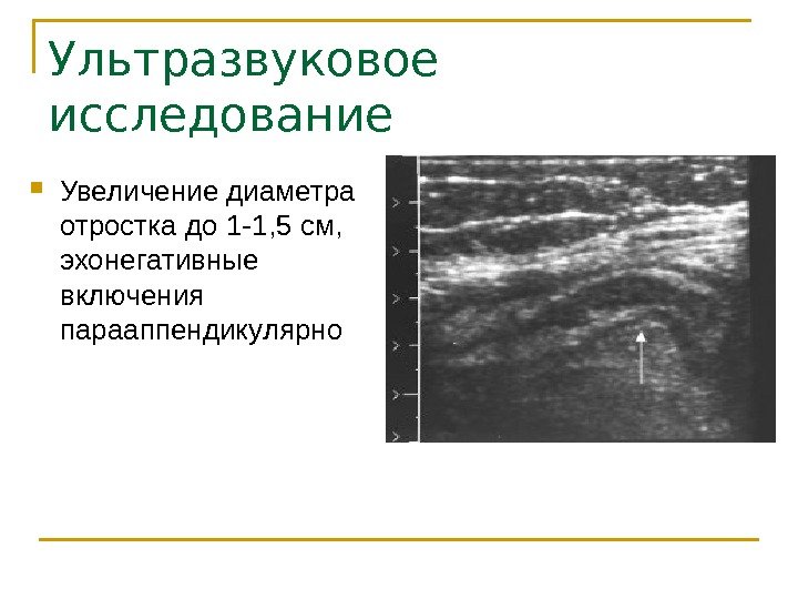 Ультразвуковое исследование Увеличение диаметра отростка до 1 -1, 5 см,  эхонегативные включения парааппендикулярно