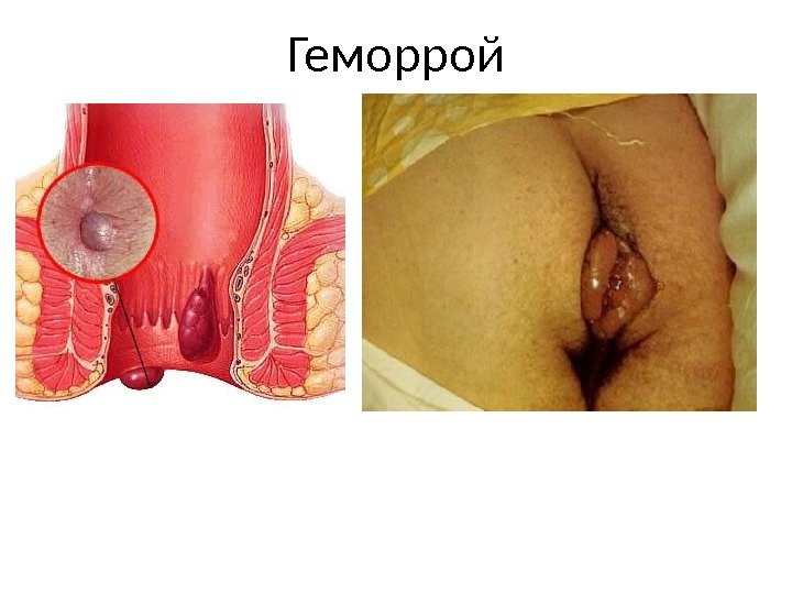 Геморрой 