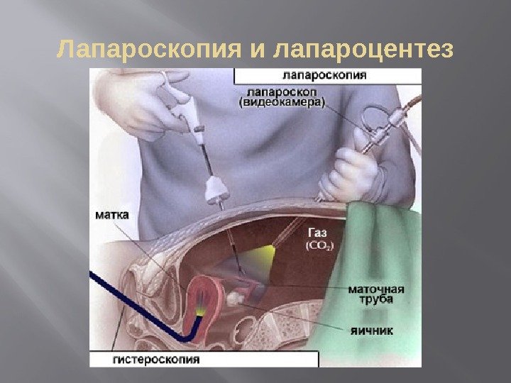 Лапароскопия и лапароцентез 