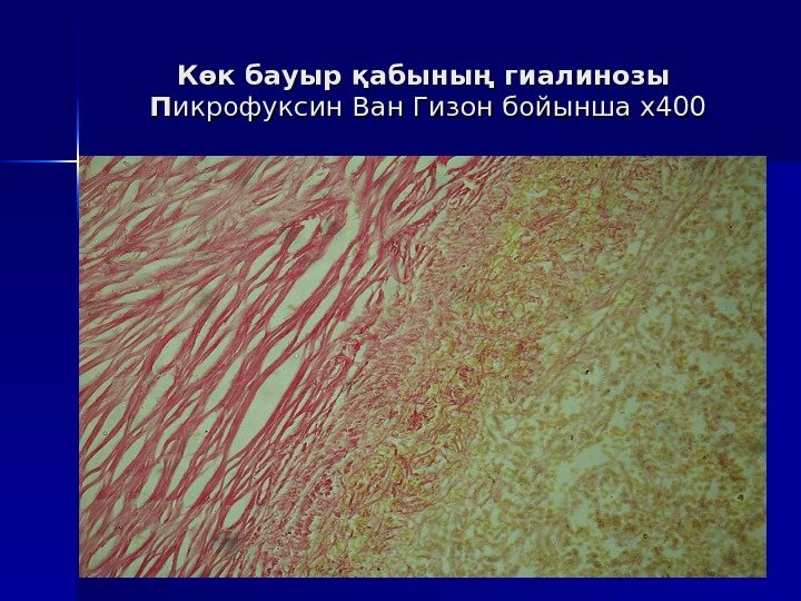 Көк бауыр қабының гиалинозы П П икрофуксин Ван Гизон бойынша х400 