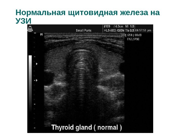 Нормальная щитовидная железа на УЗИ 