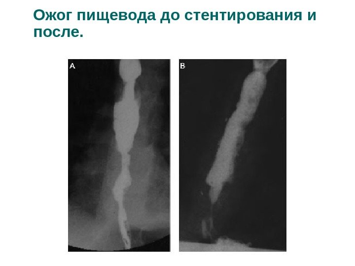 Ожог пищевода до стентирования и после. 