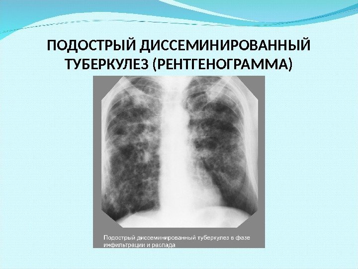 ПОДОСТРЫЙ ДИССЕМИНИРОВАННЫЙ ТУБЕРКУЛЕЗ (РЕНТГЕНОГРАММА) 