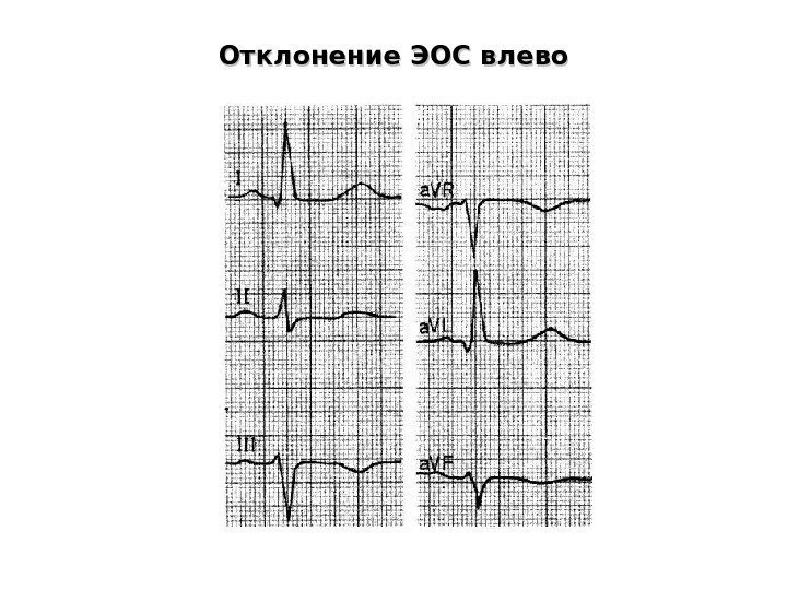   Отклонение ЭОС влево 