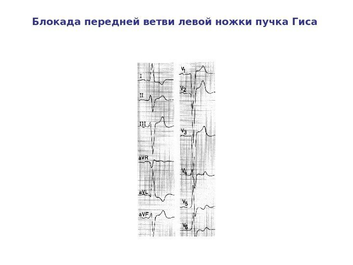   Блокада передней ветви левой ножки пучка Гиса 