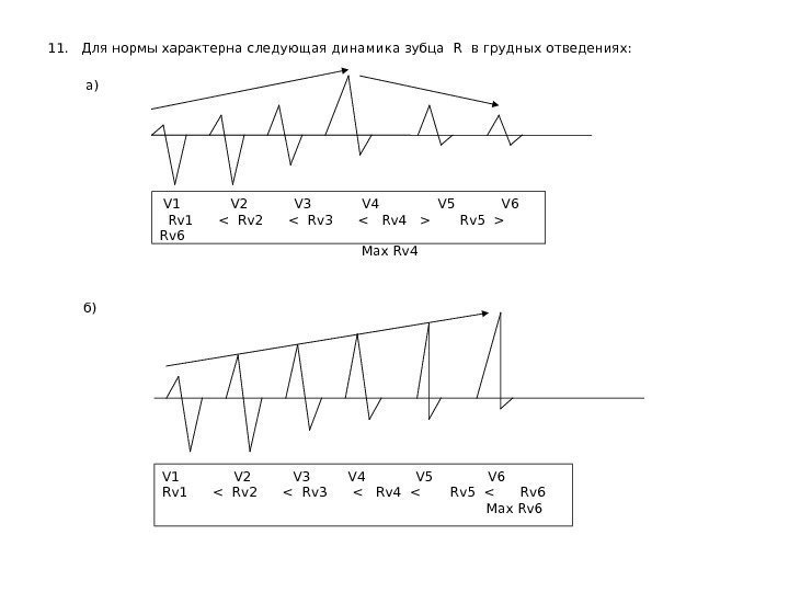   11.  Для нормы характерна следующая динамика зубца  R  в