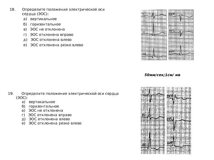  18. Определите положение электрической оси сердца (ЭОС):    а) 
