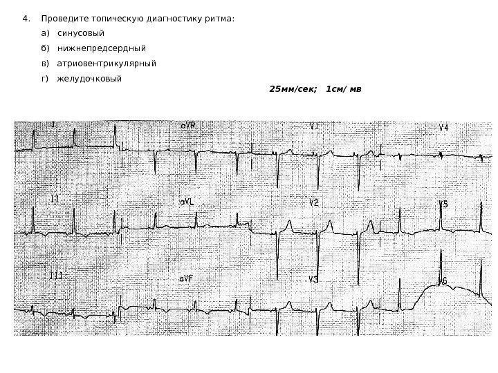   4. Проведите топическую диагностику ритма:   а)  синусовый  