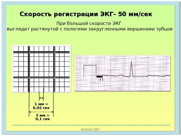   Анализ ЭКГСкорость регистрации ЭКГ- 50 мм/сек При большой скорости ЭКГ выглядит растянутой