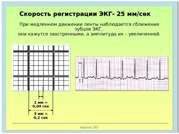   Анализ ЭКГПри медленном движении ленты наблюдается сближение зубцов ЭКГ,  они кажутся