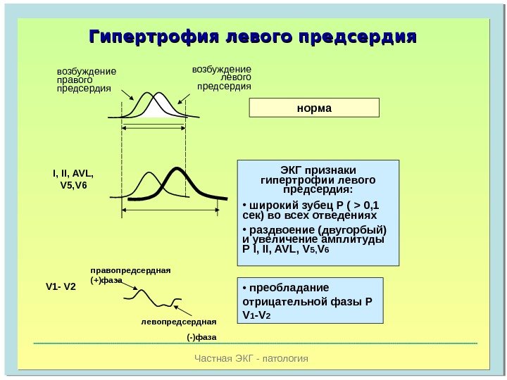   Частная ЭКГ - патология. Гипертрофия левого предсердия возбуждение правого предсердия возбуждение левого