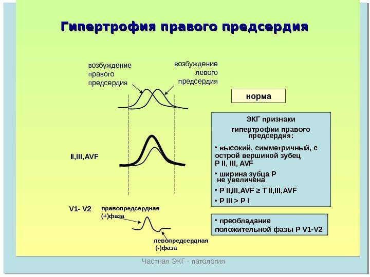   Частная ЭКГ - патологиявозбуждение правого предсердия возбуждение левого предсердия II, III, AVF