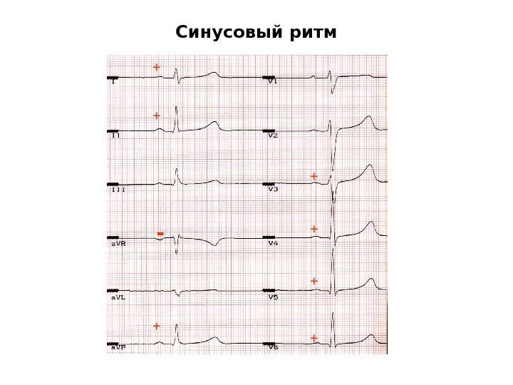   Синусовый ритм + + + +- 