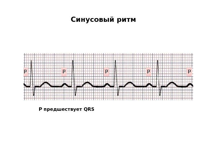   Синусовый ритм Р предшествует QRS 