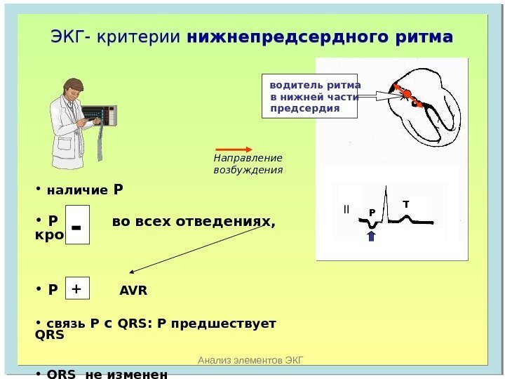   Анализ элементов ЭКГЭКГ- критерии нижнепредсердного ритма II P T водитель ритма 