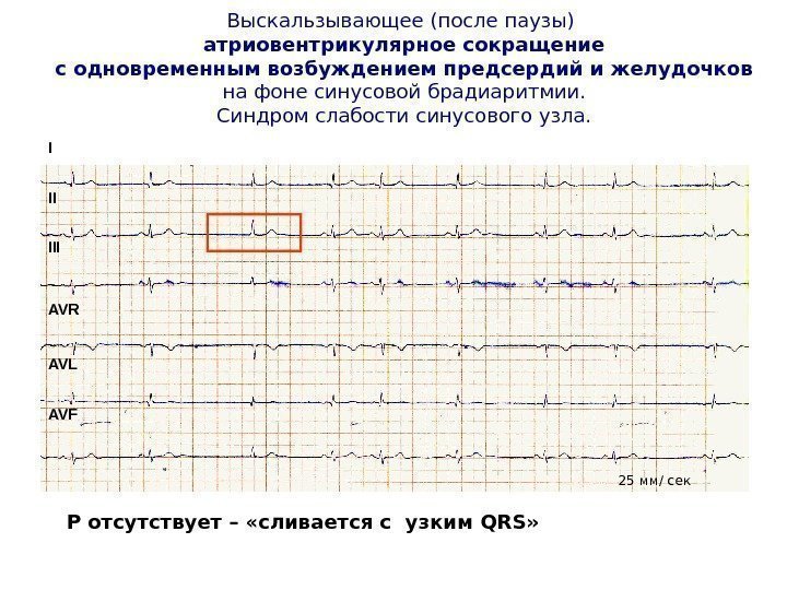   Выскальзывающее (после паузы)  атриовентрикулярное сокращение с одновременным возбуждением предсердий и желудочков