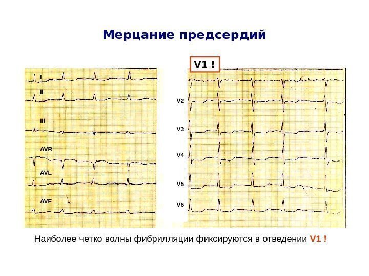   Мерцание предсердий V 1 ! Наиболее четко волны фибрилляции фиксируются в отведении