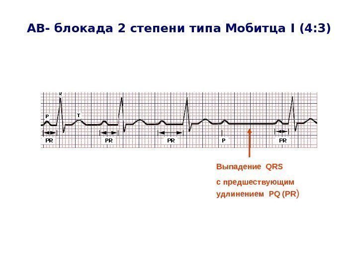   A В- блокада 2 степени типа Мобитца I (4: 3) Выпадение 