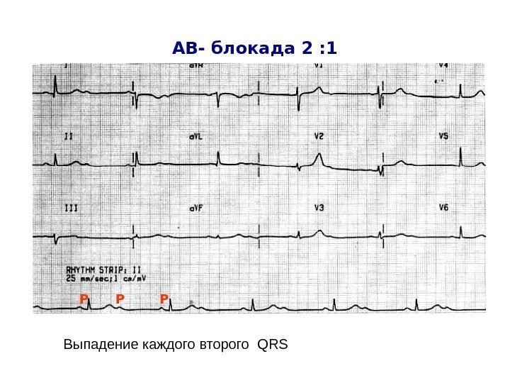   АВ- блокада 2 : 1 Р Р Р Выпадение каждого второго 