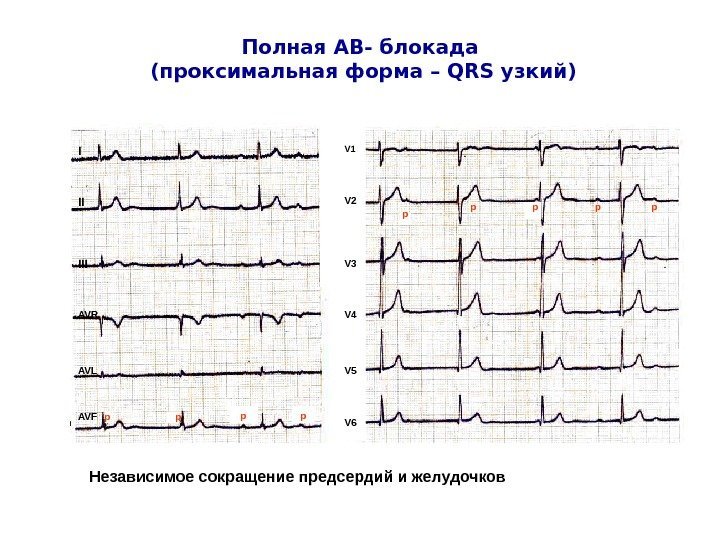   Полная АВ- блокада (проксимальная форма – QRS узкий) I II III AVR