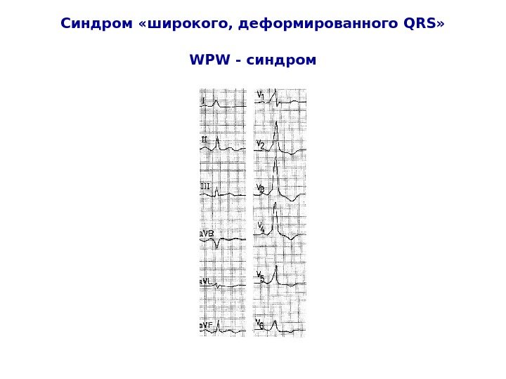   Синдром «широкого, деформированного QRS » WPW - синдром 