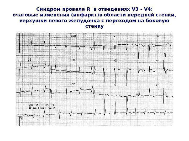   Синдром провала R  в отведениях V 3 - V 4 :