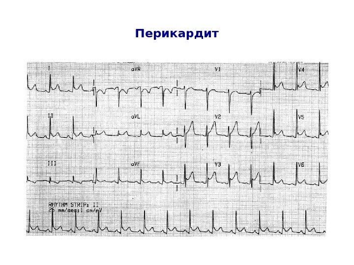   Перикардит 