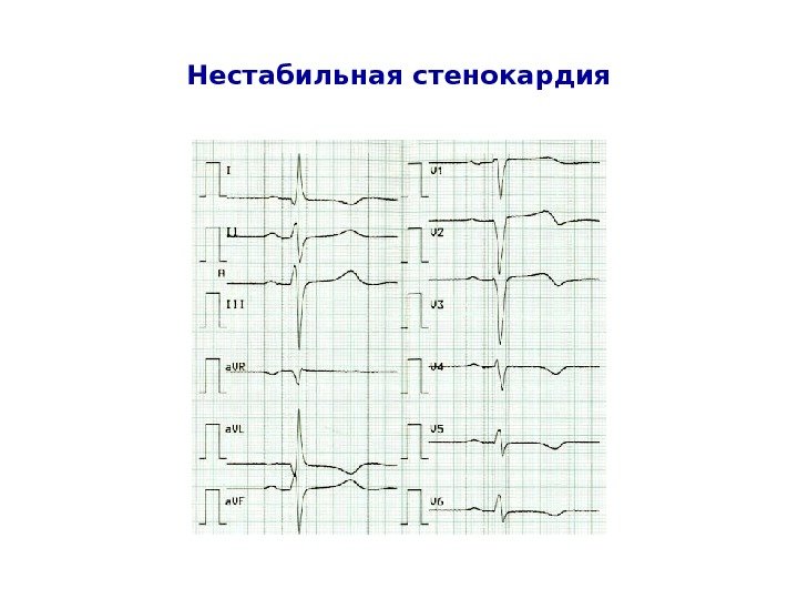   Нестабильная стенокардия 