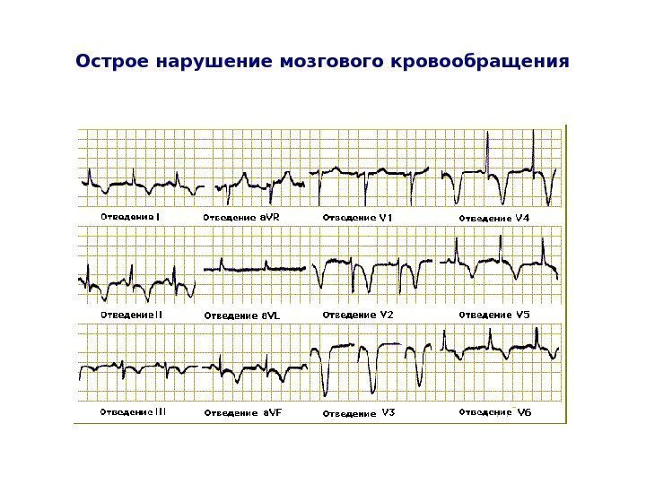   Острое нарушение мозгового кровообращения 