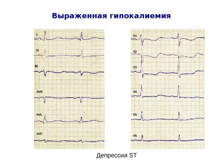   Выраженная гипокалиемия Депрессия STI II III AVR AVL AVF V 1 V