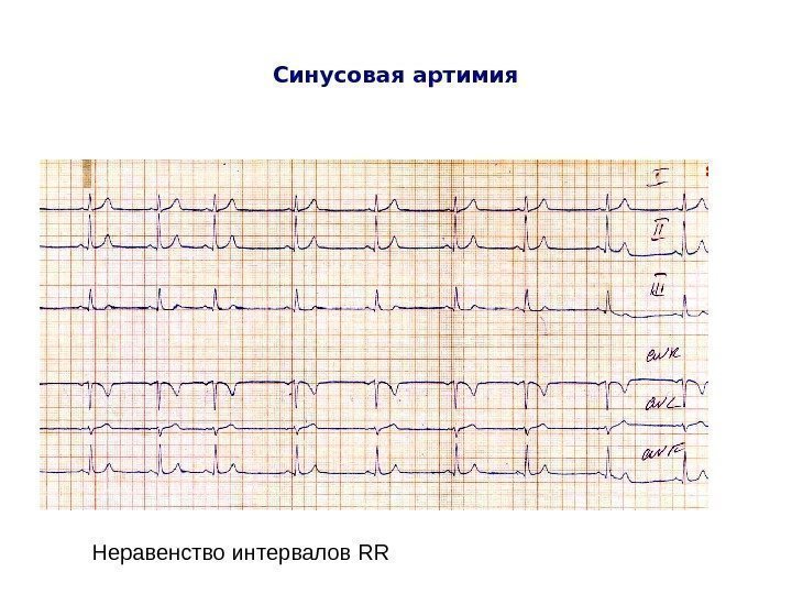   Синусовая артимия Неравенство интервалов RR 