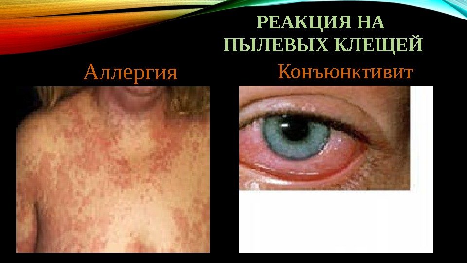 РЕАКЦИЯ НА ПЫЛЕВЫХ КЛЕЩЕЙ Аллергия  Конъюнктивит 