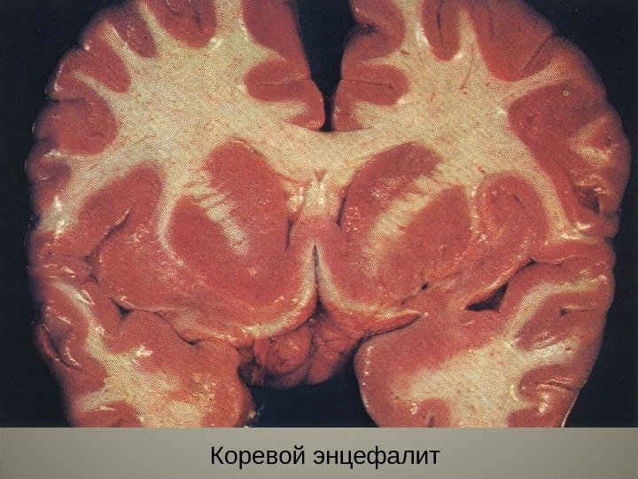 19 Коревой энцефалит 