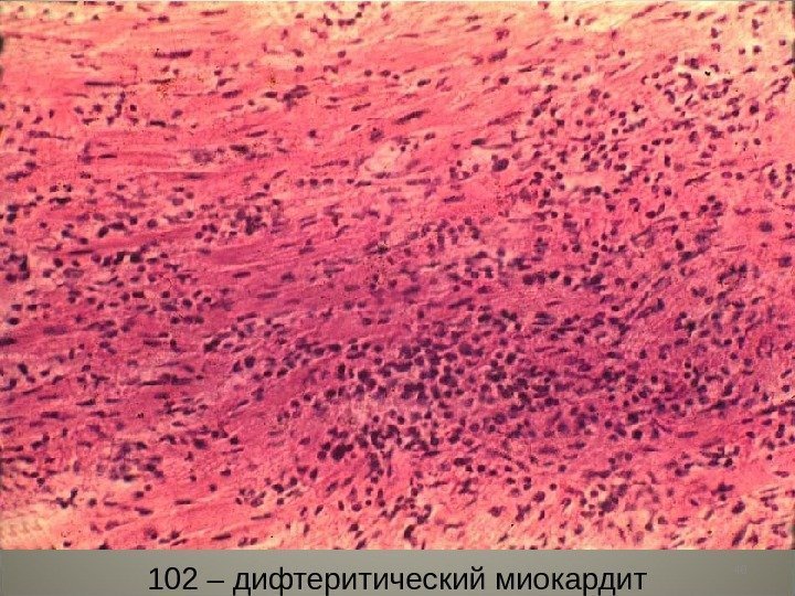 40 102 – дифтеритический миокардит 
