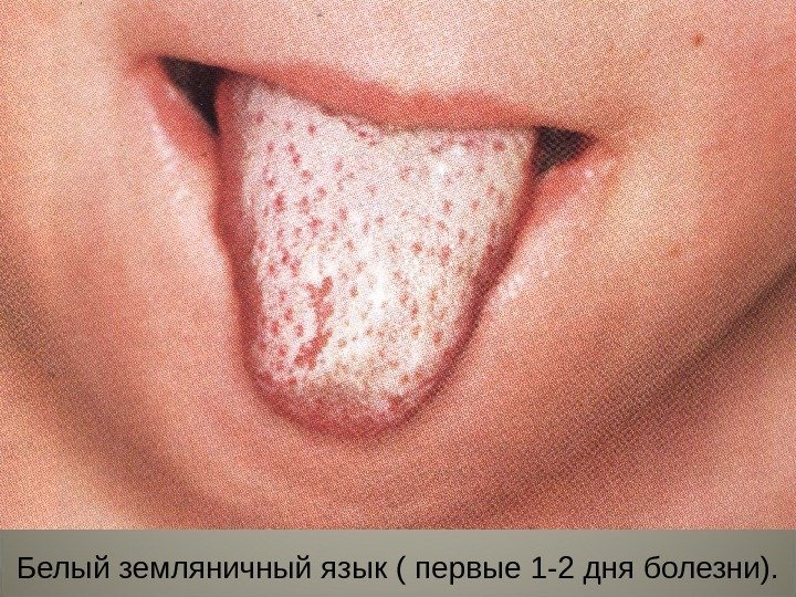 59 Белый земляничный язык ( первые 1 -2 дня болезни). 