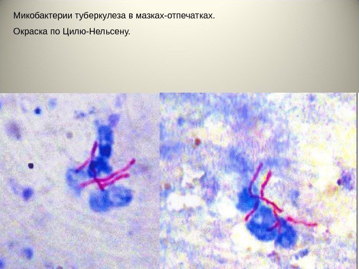 21 Микобактерии туберкулеза в мазках-отпечатках. Окраска по Цилю-Нельсену. 