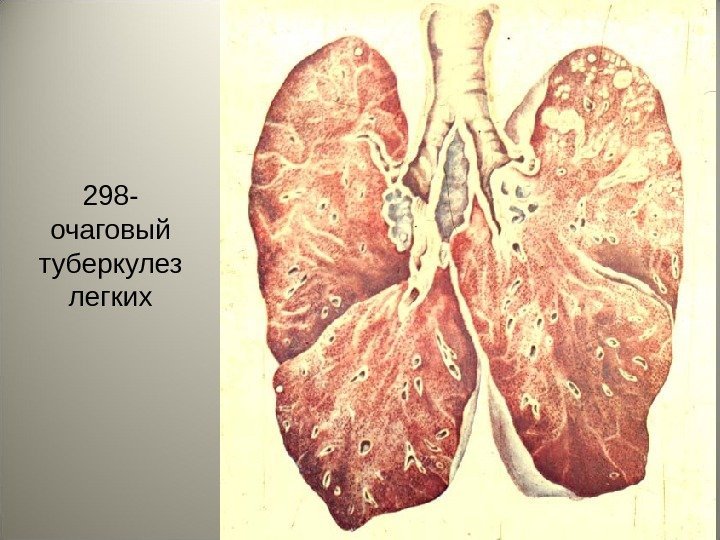 37298 - очаговый туберкулез легких 