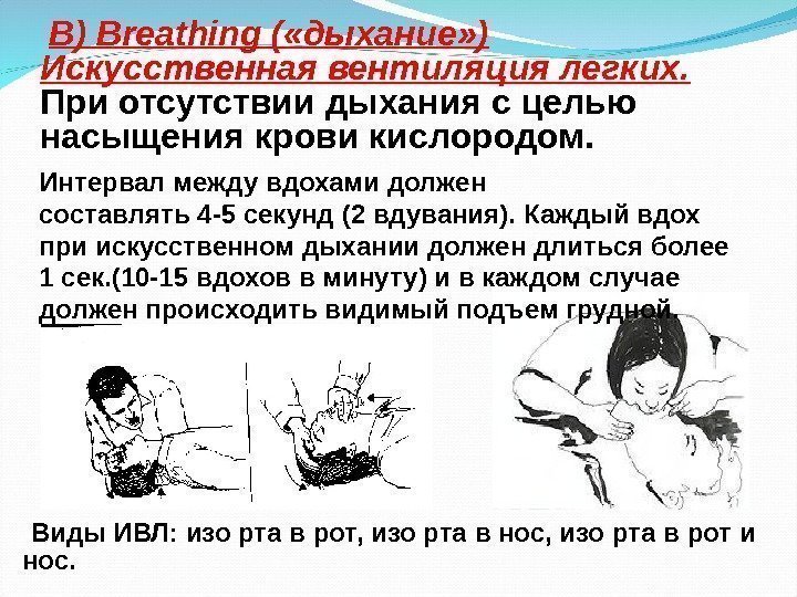  B ) Breathing ( «дыхание» ) Искусственная вентиляция легких. При отсутствии дыхания с