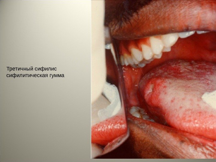 Третичный сифилис сифилитическая гумма 