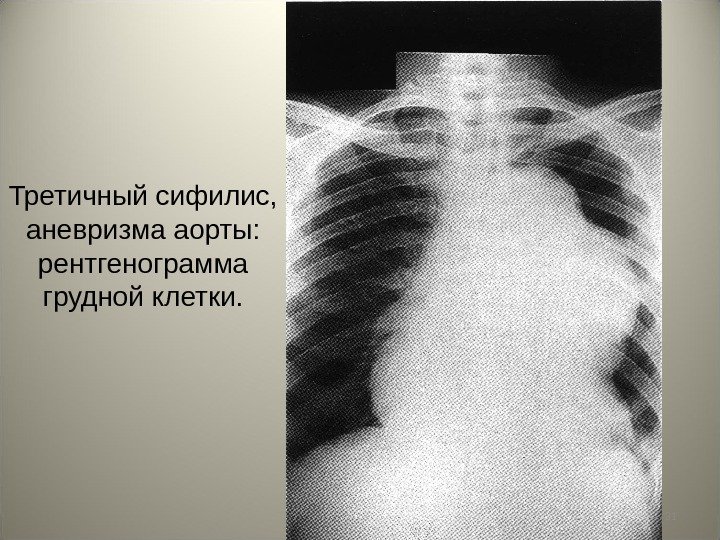 31 Третичный сифилис,  аневризма аорты:  рентгенограмма грудной клетки. 